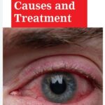 Red Eyes: Causes and Treatment