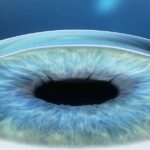 ZEISS SMILE: Pioneering Vision Correction Technology
