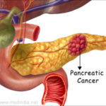 Pancreatic cancer-how to prevent it?