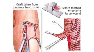 Skin donation and skin banking- it has high benefit to the mankind.