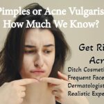 How to get rid of Pimples or Acne Vulgaris