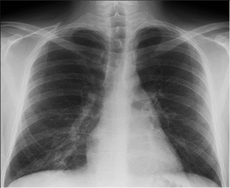 Normal Lungs