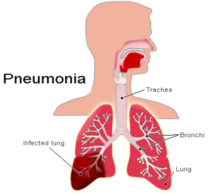 pneumonia