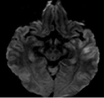 MRI picture showing early stroke changes