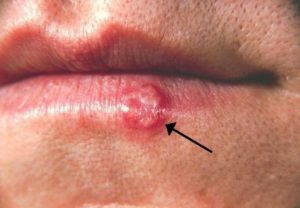 Herpes ulcer on lower lip