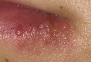 Herpes on lips -   blisters and pustules