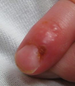 Herpes lesions on finger called Whitlow