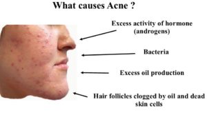  causes of Acne
