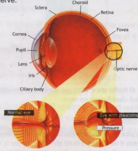 Glaucoma