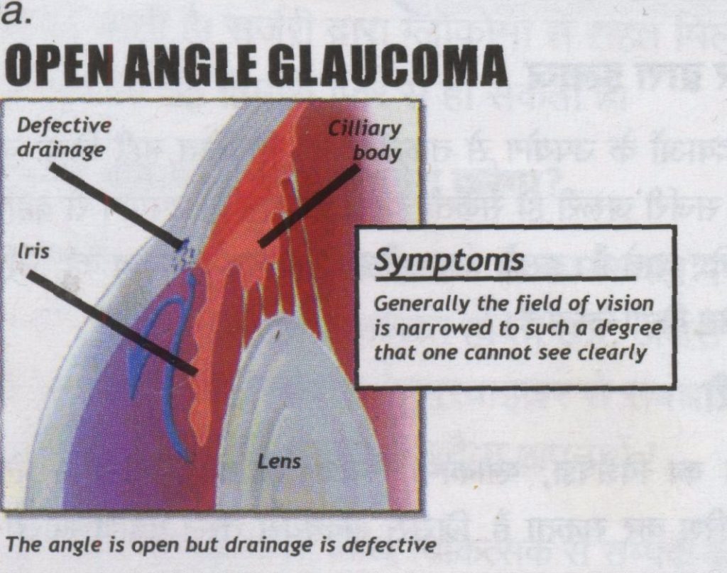 Open angle glaucoma - Health Vision