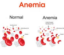 Anaemia :10 Superfoods for increasing the blood health