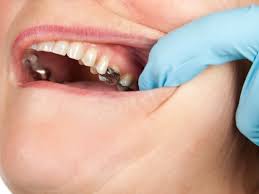 amalgam fillings in their children’s cavities