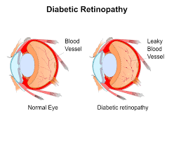 Diabetic retinopathy