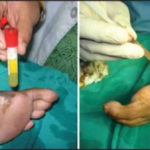 What is the treatment for 'Non-Healing Diabetic Foot Ulcers (DFUs)'?