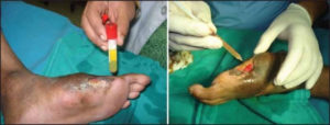Diabetic foot ulcers (DFUs)