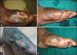 Diabetic foot ulcers (DFUs)