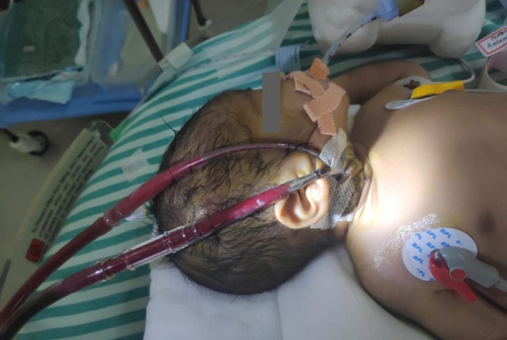 a baby with Meconium aspiration syndrome (MAS) and neonatal sepsis