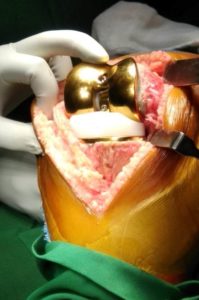 Golden Knee Replacement’ surgery