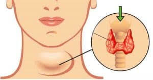 Hypothyroidism- one of the commonest problems faced by women!?