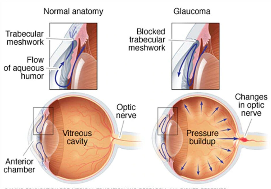 Glaucoma-eye