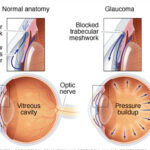 Glaucoma - disease of the optic nerve