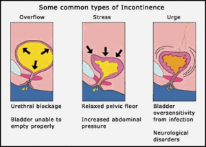 overflow incontinence sdn