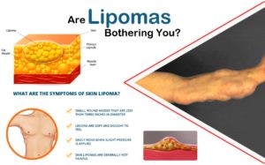 Lipomas-fatty-benign