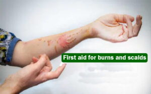 first-aid-for-burns-and-scalds