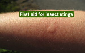 first-aid-for-insect-stings