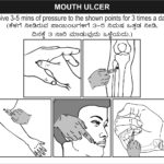 Acupuncture treatment for Mouth Ulcer