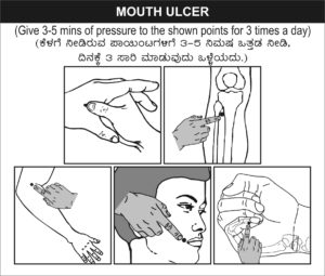 Acupuncture treatment for Mouth-ulcer.