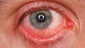 Allergic conjunctivitis - erratic weather and pollution is the main reason?