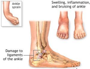 pain around heel and ankle