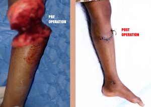 Leg replantation surgery at Sparsh hospital