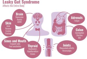gut-syndrome-