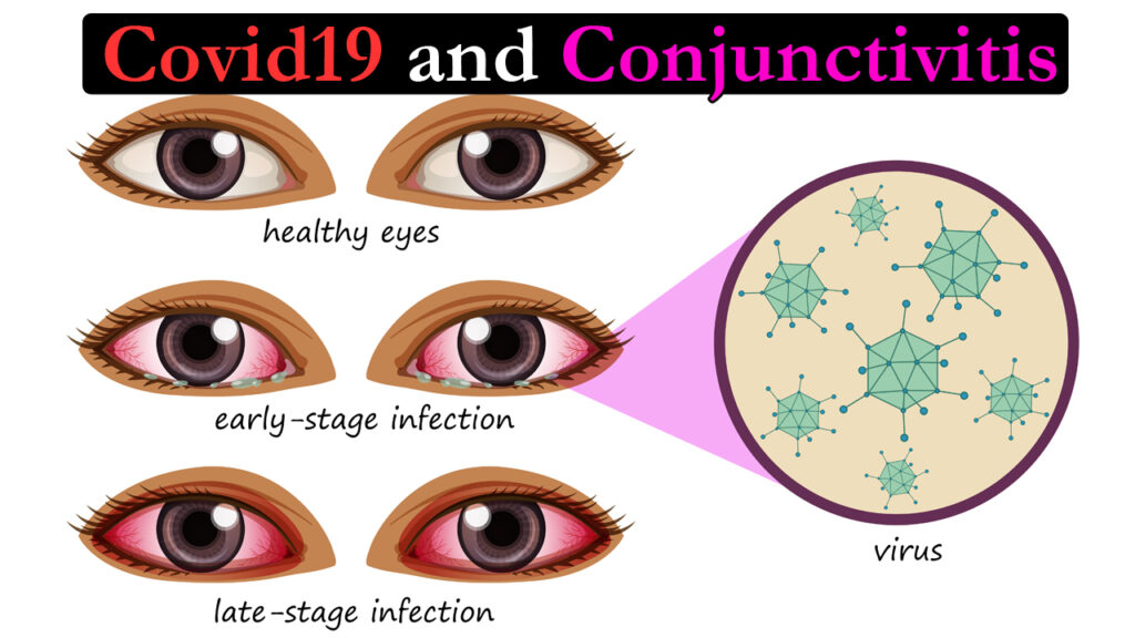 Acute conjunctivitis - the only presenting sign and symptom in Covid 19 ? -
