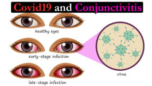Acute conjunctivitis - the only presenting sign and symptom in Covid 19 ?