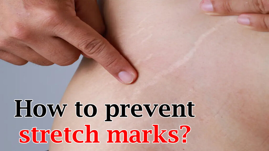 how-to-prevent-stretch-marks