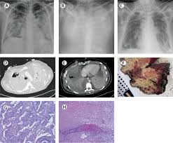 lung-transplant