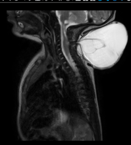 Aster RV doctors successfully perform neuromonitoring on 5 day old baby