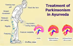 PARKINSONISM