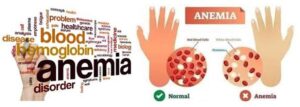 National Anaemia Day to be observed on 21st March 