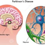 Parkinson’s Disease (PD) – Causes, Symptoms, Diagnosis, Treatments