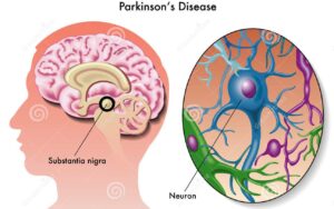 Parkinson’s Disease (PD) – Causes, Symptoms, Diagnosis, Treatments