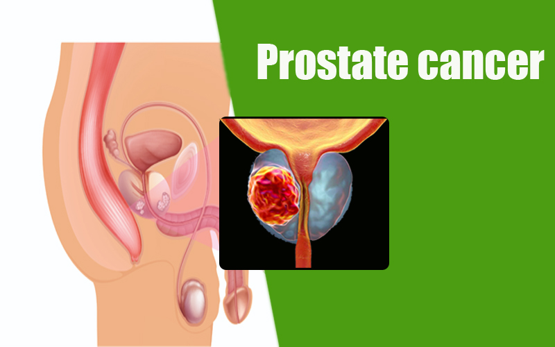 Prostatitis rákos szakasz