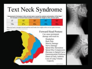 text-neck-syndrome