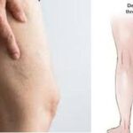 Leg pain or muscle cramps?- It could be symptoms of deep vein thrombosis