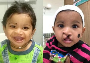 Moinuddin-before-and-after-the-surgery