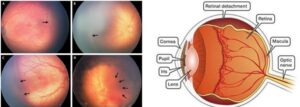 Retinopathy of prematurity - is it a new disease and how to prevent blindness?