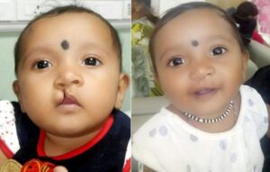 Saakshi-before-and-after-after-the-Surgery